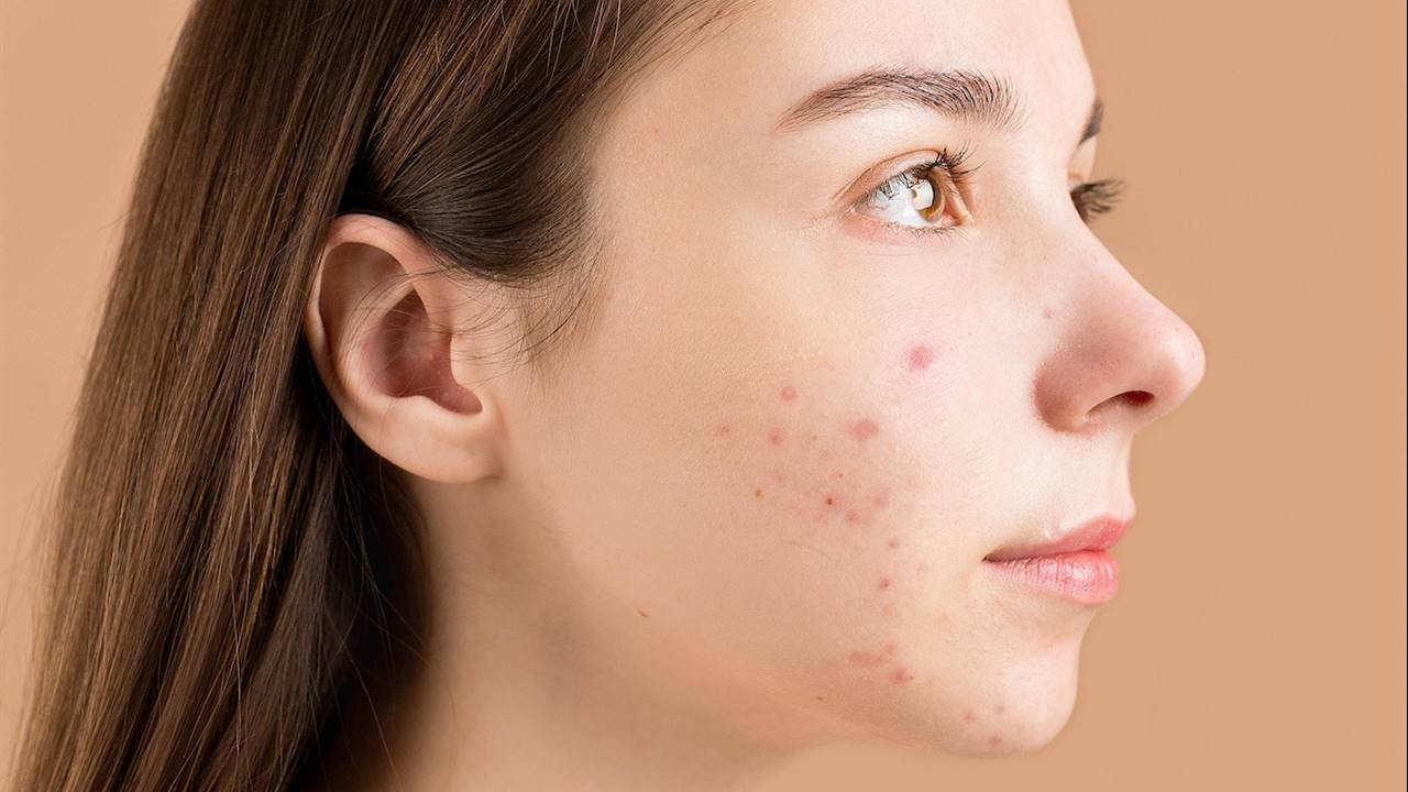 ¿Cómo impacta estrés en la piel? Tips para combatirlo