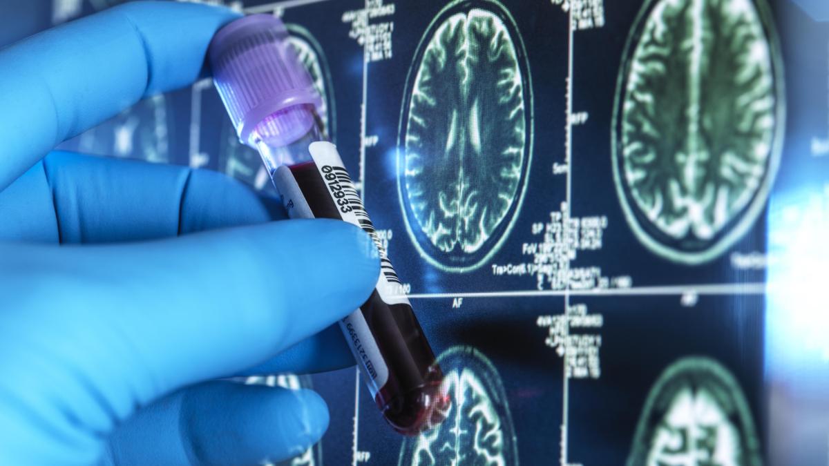 Avance en el diagnóstico de Alzheimer: Nuevo test de sangre preciso